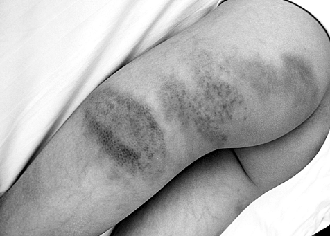 陽陽身上的傷讓人不忍心看 陽陽身上的傷讓人不忍心看