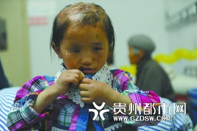 被燙傷的頭皮一直沒有愈合。