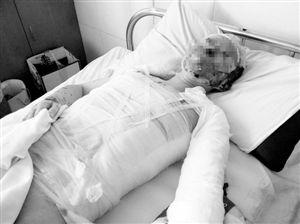 周小姐的頭、頸、軀干、四肢均被燒傷，其中面部燒傷最為嚴(yán)重。