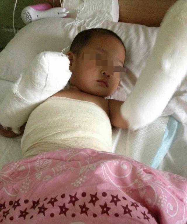 2歲娃洗澡跌入開水鍋 雙手嚴(yán)重燙傷