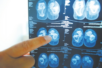 X光片顯示,確實(shí)有一根殘留的螺絲釘。