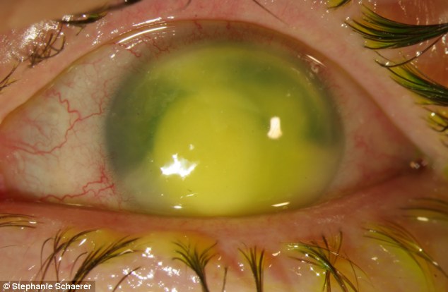 恐怖慎入！隱形眼鏡致英女子摘除眼球