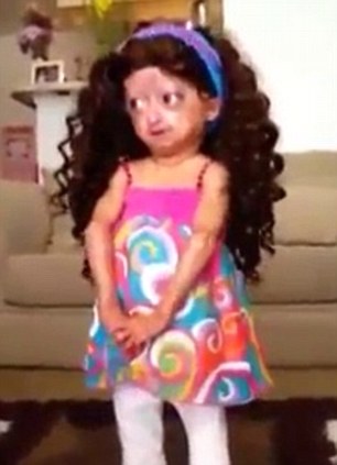 女童患罕見早衰癥 女童患罕見早衰癥