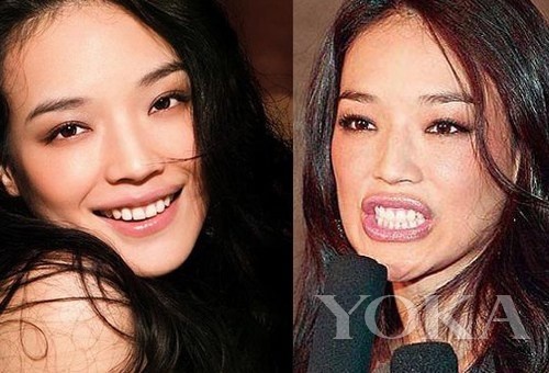 牙齒凸出，口輪肌過于松弛