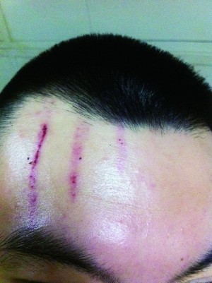 　2013年，被打者受傷照