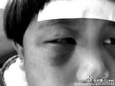 6月2日，網(wǎng)曝渭南市臨渭區(qū)一不滿5歲的女童遭奶奶毆打，眼圈青腫，引起網(wǎng)友關(guān)注，但孩子父母和爺爺均稱是摔倒導(dǎo)致。相關(guān)部門介入調(diào)查發(fā)現(xiàn)確為奶奶毆打所致，鑒于其身體原因已進行批評教育。