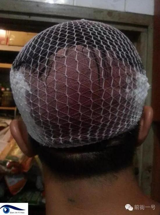 李律師受傷后縫合三針。