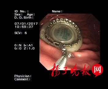 男子喝酒太猛吞下瓶蓋 醫(yī)生用避孕套取出 男子喝酒太猛吞下瓶蓋 醫(yī)生用避孕套取出