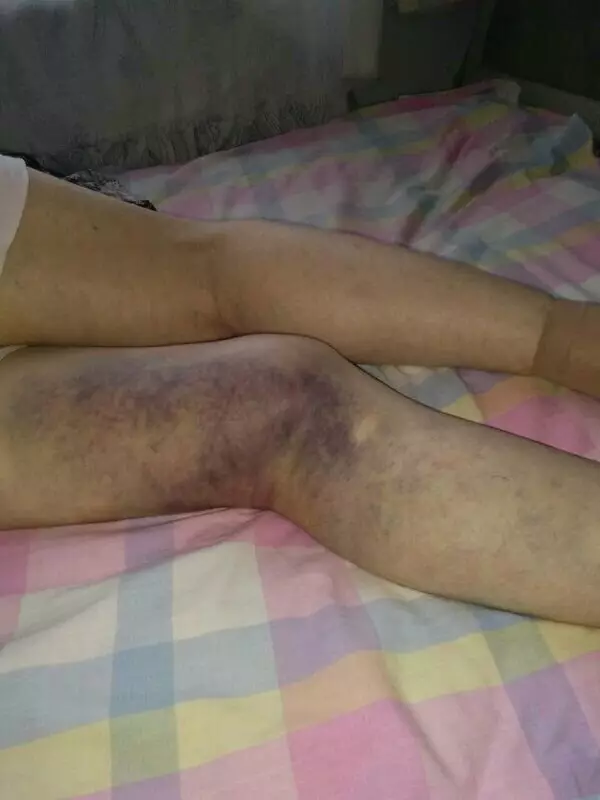 八旬老太被美容院洗腦交7萬元 腿沒治好反病倒 八旬老太被美容院洗腦交7萬元 腿沒治好反病倒