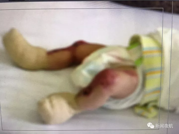 女嬰先天皮膚缺失 體表10%無(wú)皮膚鮮紅肌肉暴露在外