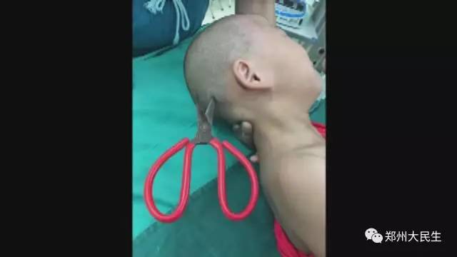 剪刀插入6歲女孩頭部 圖片讓人心驚膽戰(zhàn) 剪刀插入6歲女孩頭部 圖片讓人心驚膽戰(zhàn)