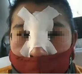 女子做隆鼻后化膿腐爛 女子做隆鼻后化膿腐爛