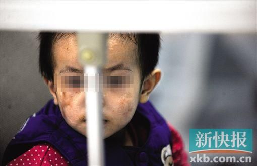 去年3月就能出院的小華(化名),目前還在廣州市婦兒醫(yī)療中心的PICU里住著。新快報記者 孫毅/攝