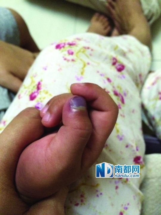 小逸手指被夾傷。