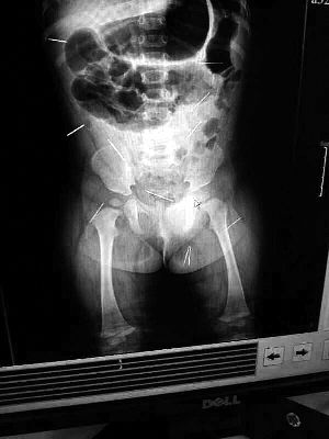 目前體內(nèi)的12根鋼針多分布在孩子的臀部，一根在腹部，其余3根在胸腔附近，其中一根很接近心臟