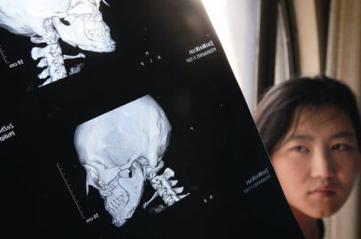 國(guó)內(nèi)醫(yī)院CT顯示，如今靳魏坤的鼻子假體是歪的，連下巴也是歪的