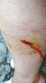 郭女士腿上被猴子咬的傷口。(受訪者供圖)